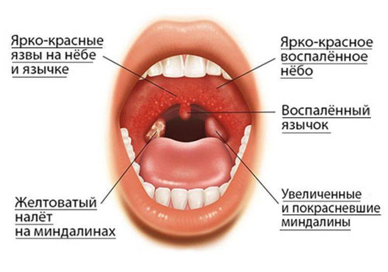 Герпесная ангина у детей: как выявить и быстро вылечить?