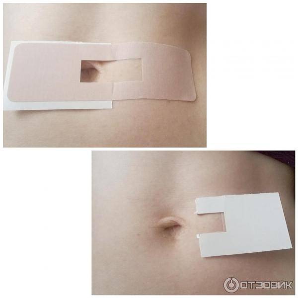 Специальный пластырь для пупочной грыжи для новорожденных