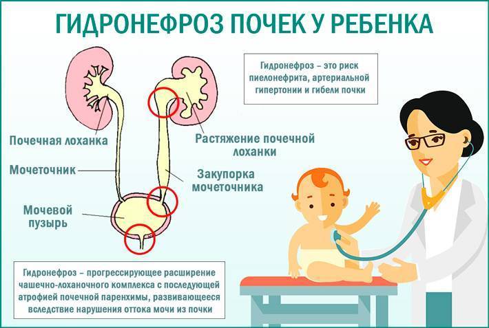 Условия развития пиелоэктазии, риски и варианты лечения