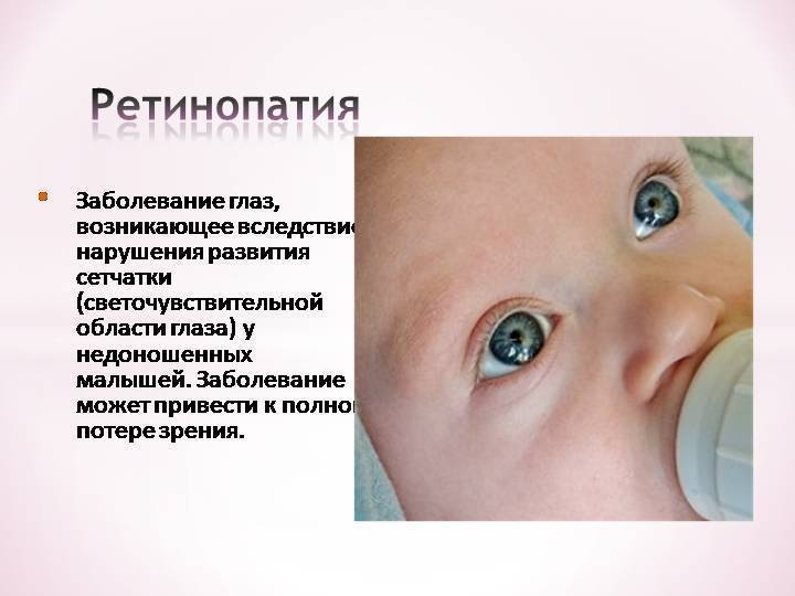 Ретинопатия у недоношенных детей: стадии и степени, причины, симптомы, диагностика и лечение, последствия и профилактика + фото