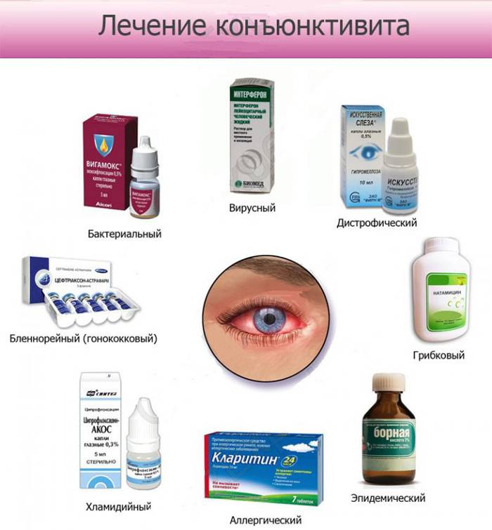 Как быстро вылечить конъюнктивит: лучшие способы