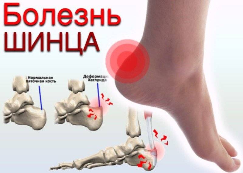 ᐈ как избавиться от деформации хаглунда? ~【лечение в киеве】