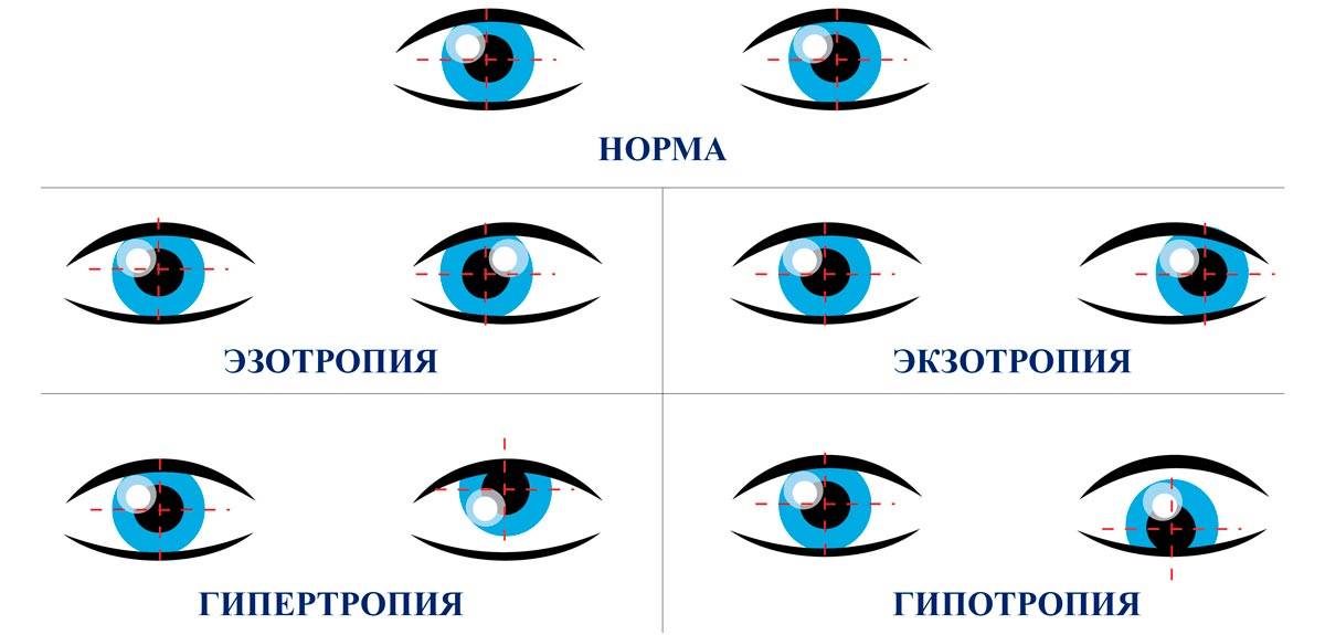Косоглазие у новорожденных - когда проходит, до какого возраста это норма