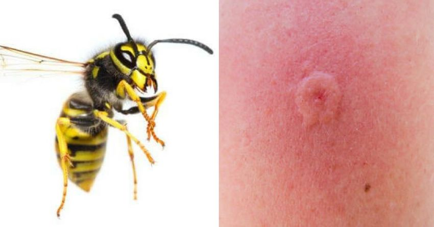 Как выглядит укус осы и пчелы - медицинская энциклопедия
