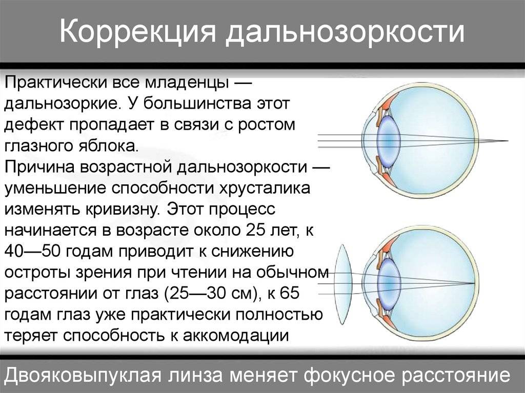 Дальнозоркость (гипермиотропия)