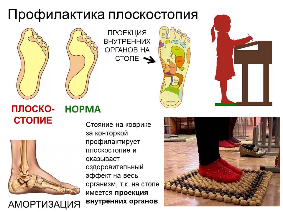 Плоскостопие