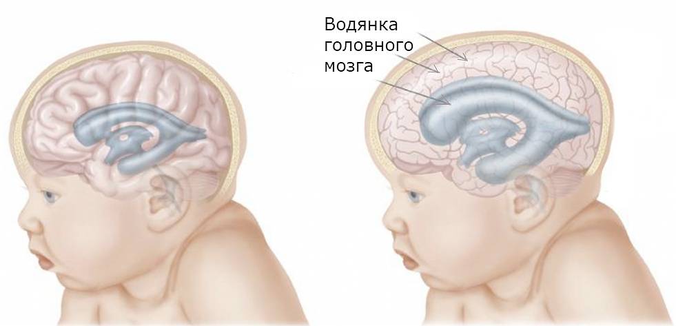 Возможные осложнения и последствия при отеке головного мозга у новорожденных