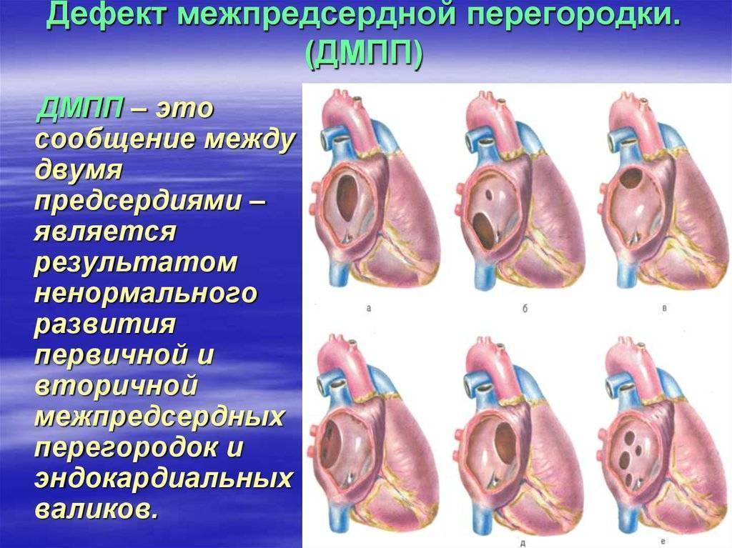 У новорожденного дмпп: что такое дефект межпредсердной перегородки и нужна ли операция детям?