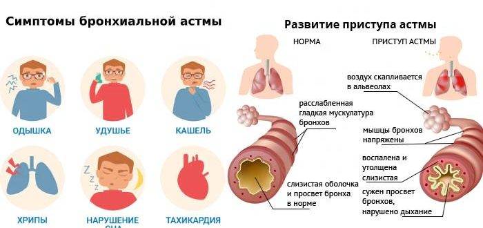 Бронхиальная астма у детей: симптомы и лечение, профилактика заболевания