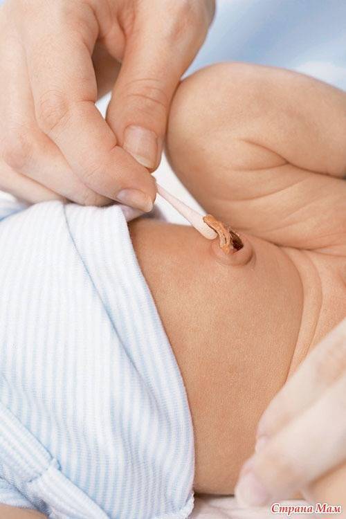 Фунгус пупка у новорожденных: фото, лечение гранулемы солью (совет комаровского)