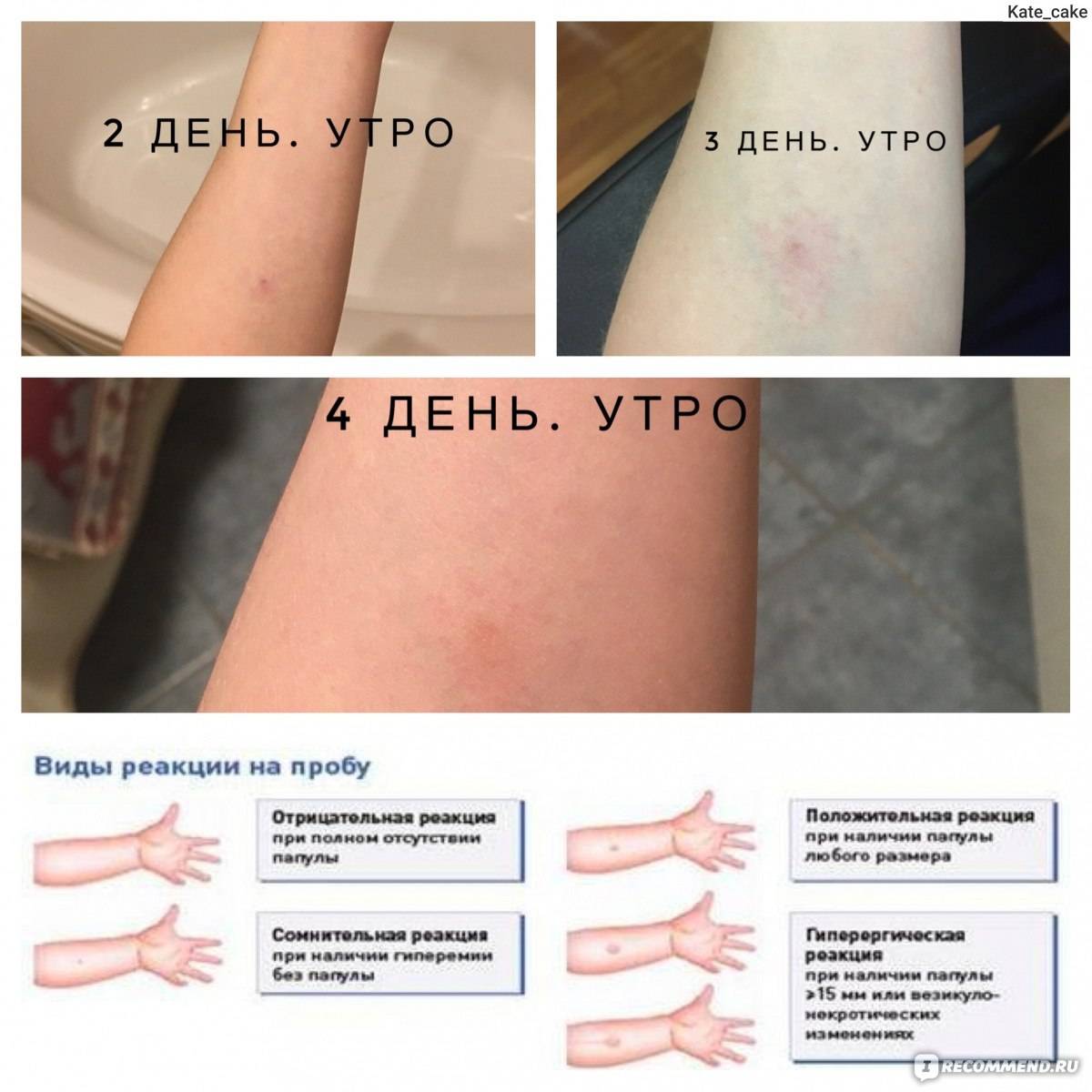 Расшифровка результатов манту у детей: как понять реакцию на пробу туберкулина
