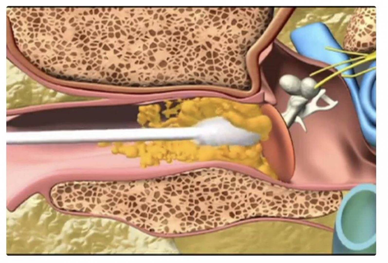 Серная пробка в ухе у ребенка — что делать?