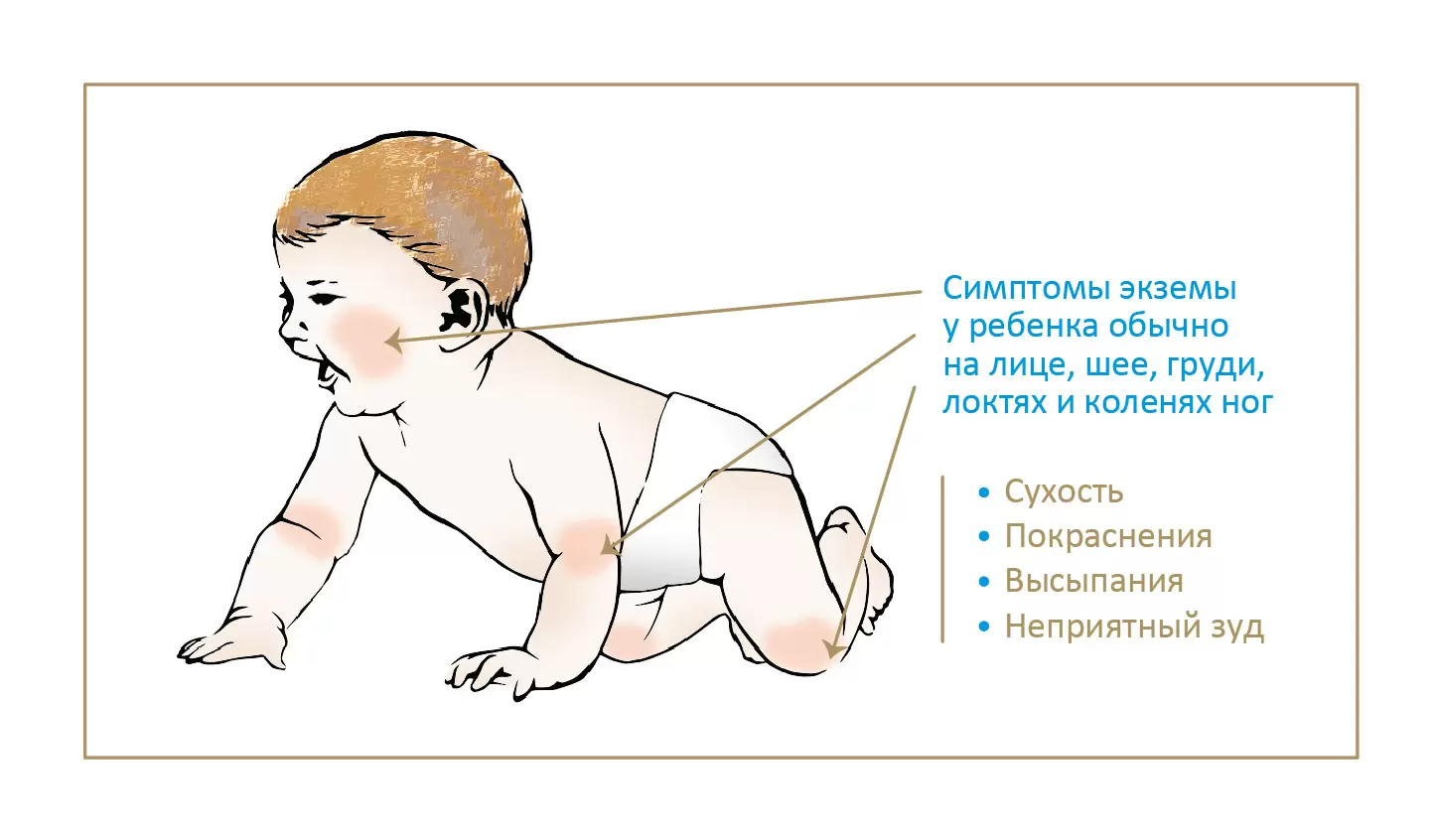 Диатез на лице у грудничка — как выглядит и чем лечить?