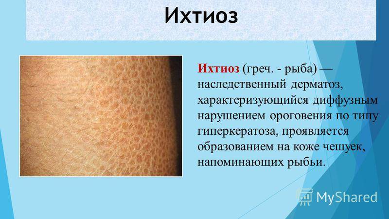 Ихтиоз кожи у детей: опасно ли это заболевание для новорожденных, что делать и как лечить?