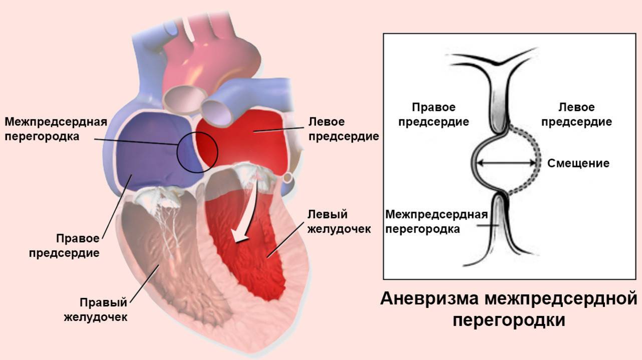 Дефект межпредсердной перегородки у новорожденных, детей и взрослых