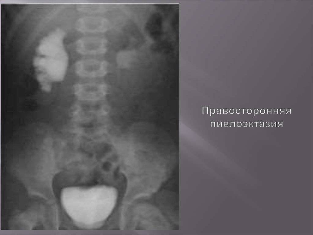 Пиелоэктазия почки у ребенка комаровский — почки