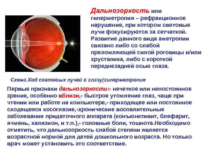 Дальнозоркость у детей - норма, лечение, причины гиперметропии