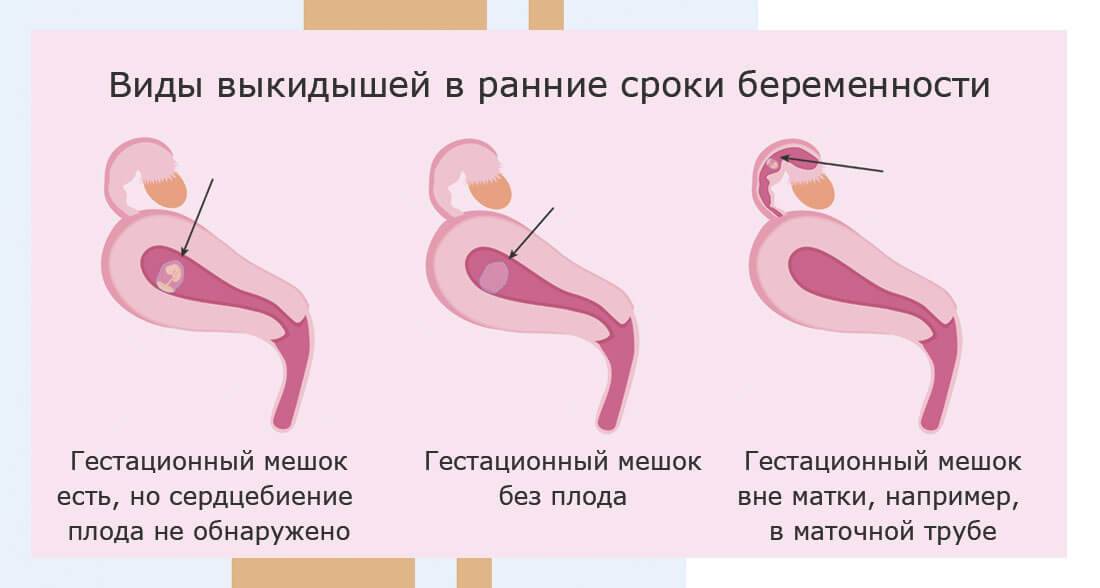 Секс после выскабливания матки: когда можно начинать?