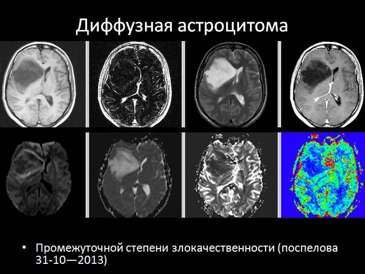 Опухоль головного мозга у детей: симптомы ранних и поздних стадий, прогноз диффузной глиомы ствола