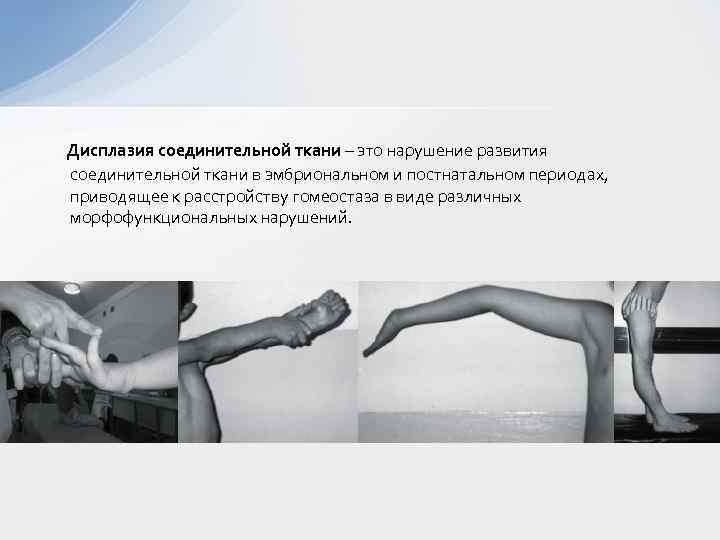 Какие симптомы указывают на дисплазию соединительной ткани: проявления у детей и взрослых