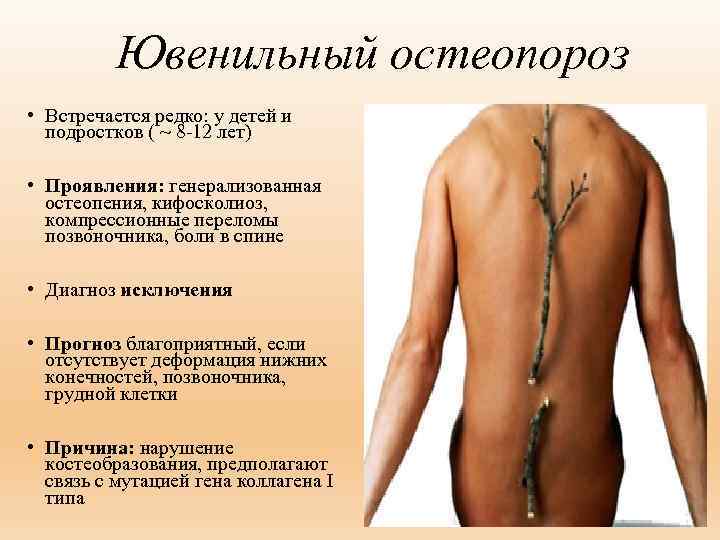 Ювенильный остеопороз: причины, симптомы и лечение