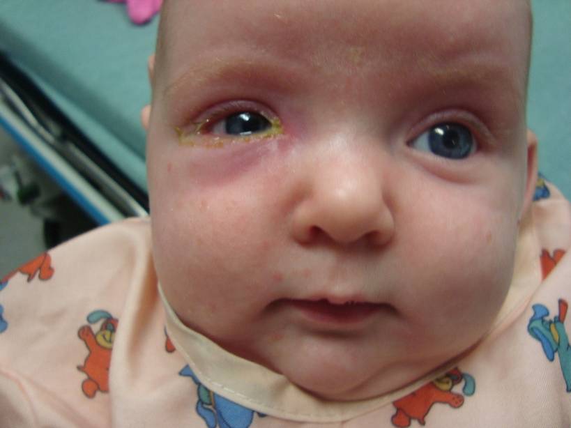 Что делать, когда у ребенка закисают глаза - офтальмологические клиники «эксимер» (киев) – диагностика и лечение заболеваний глаз у взрослых и детей