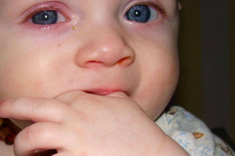 Закисшие глаза у ребенка: причины и лечение по комаровскому