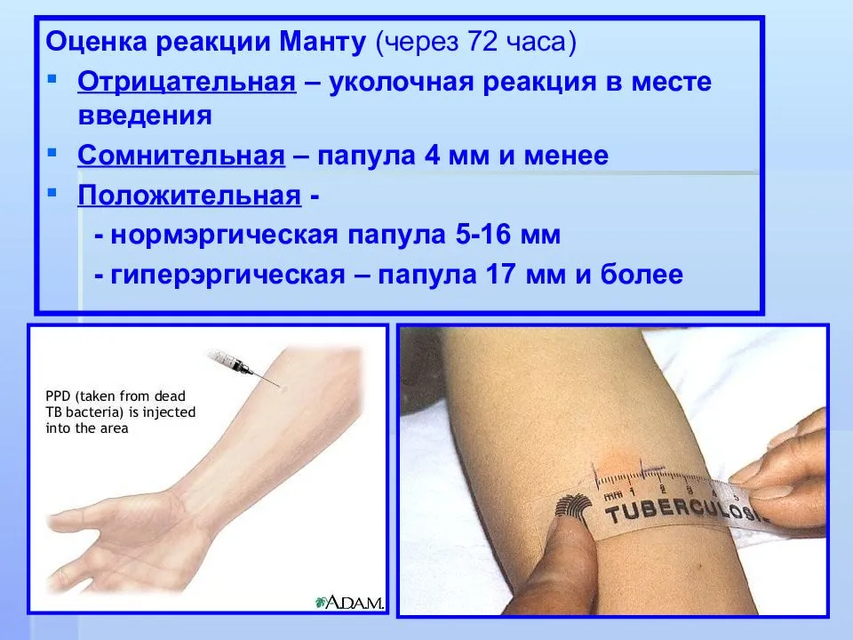 Альтернатива манту