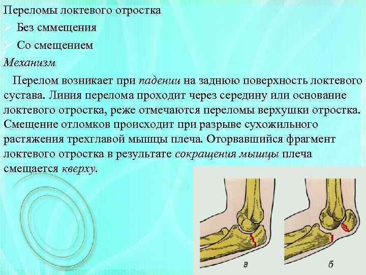 Симптомы перелома руки у ребенка со смещением и без, методы диагностики и лечения