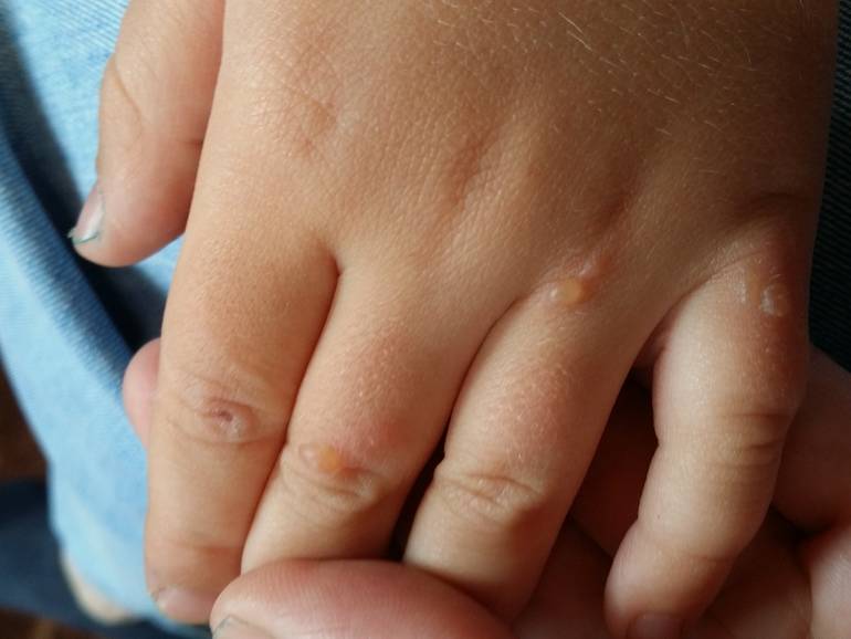 Сыпь на теле у ребенка - фото с пояснениями: мелкая, красная, похожая на мурашки и другие виды