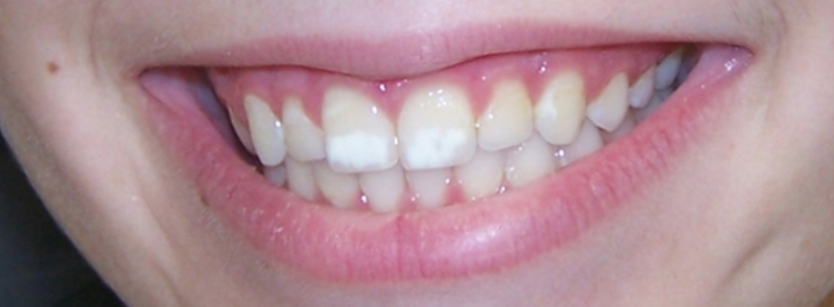 Коричневый налет на зубах у ребенка: причины и методы устранения