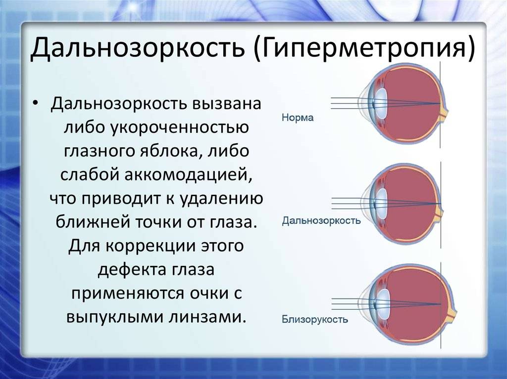 Дальнозоркость у детей: определение патологии