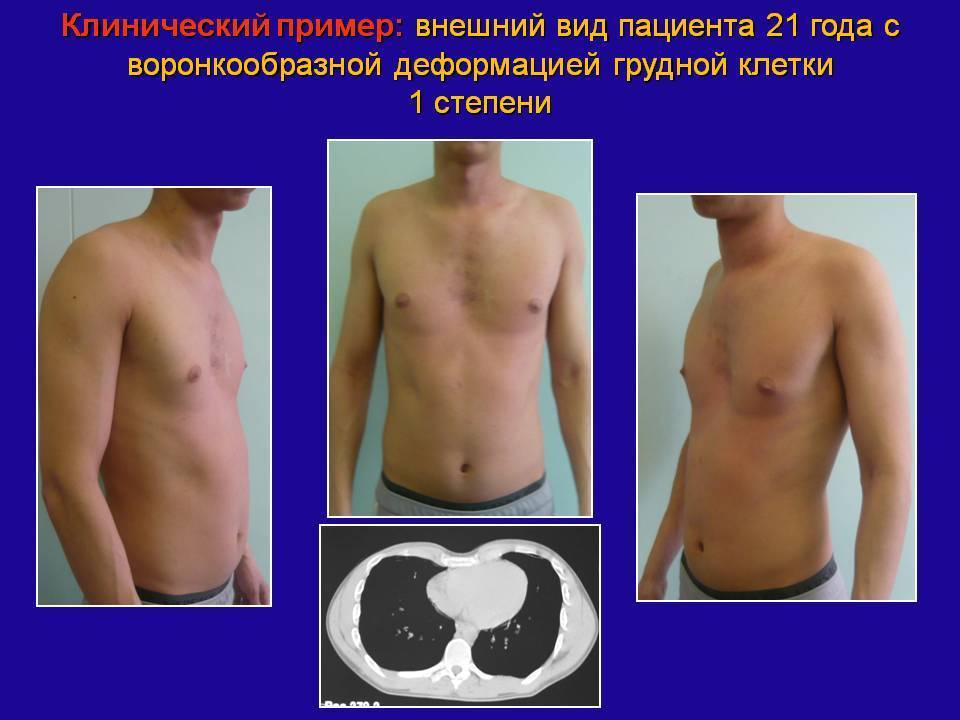 Воронкообразная грудная клетка у ребенка: фото, лечение без операции, операция