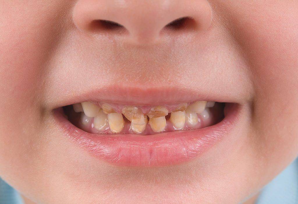 Налет на зубах у ребенка: причины и методы устранения