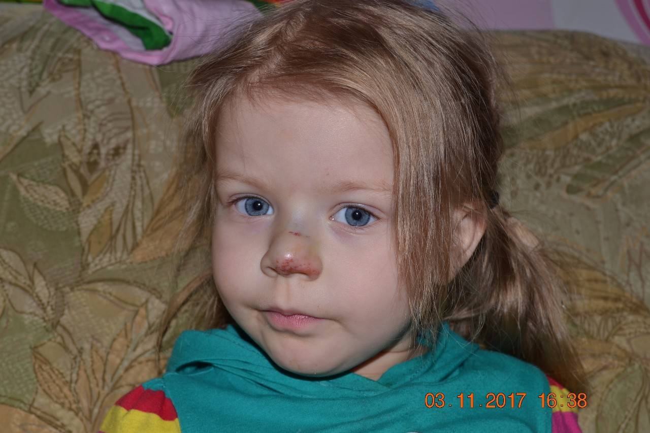 Перелом носа у ребенка: симптомы травмы после падения малыша, диагностика и лечение