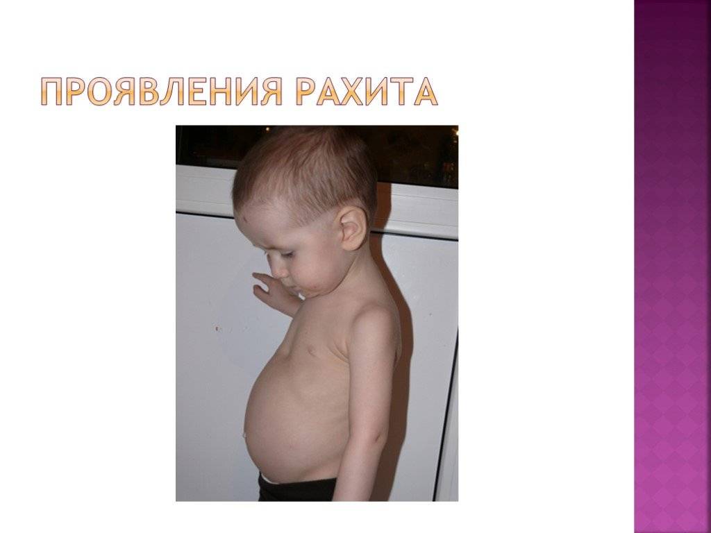 Рахит: признаки, причины, лечение и профилактика / mama66.ru