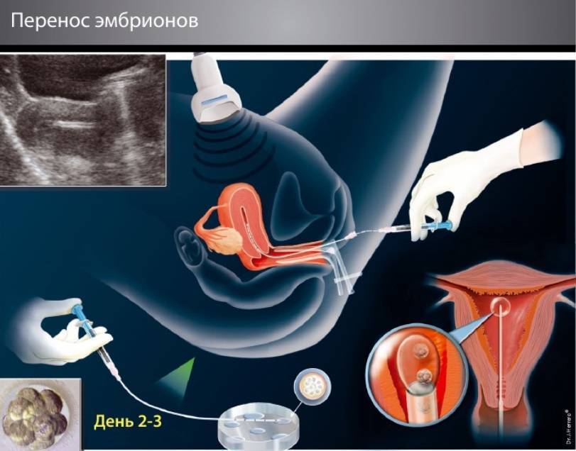 Жизнь после переноса эмбрионов | что рекомендуют врачи
