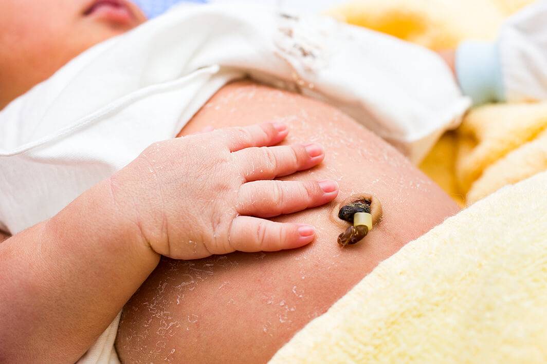 Гранулема пупка у новорожденных: что такое, симптомы, причины возникновения, лечение, профилактика
