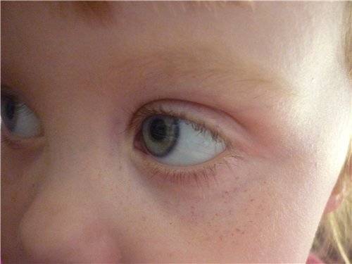 Красные пятна под глазами у ребенка: причины и методы лечения - "здоровое око"