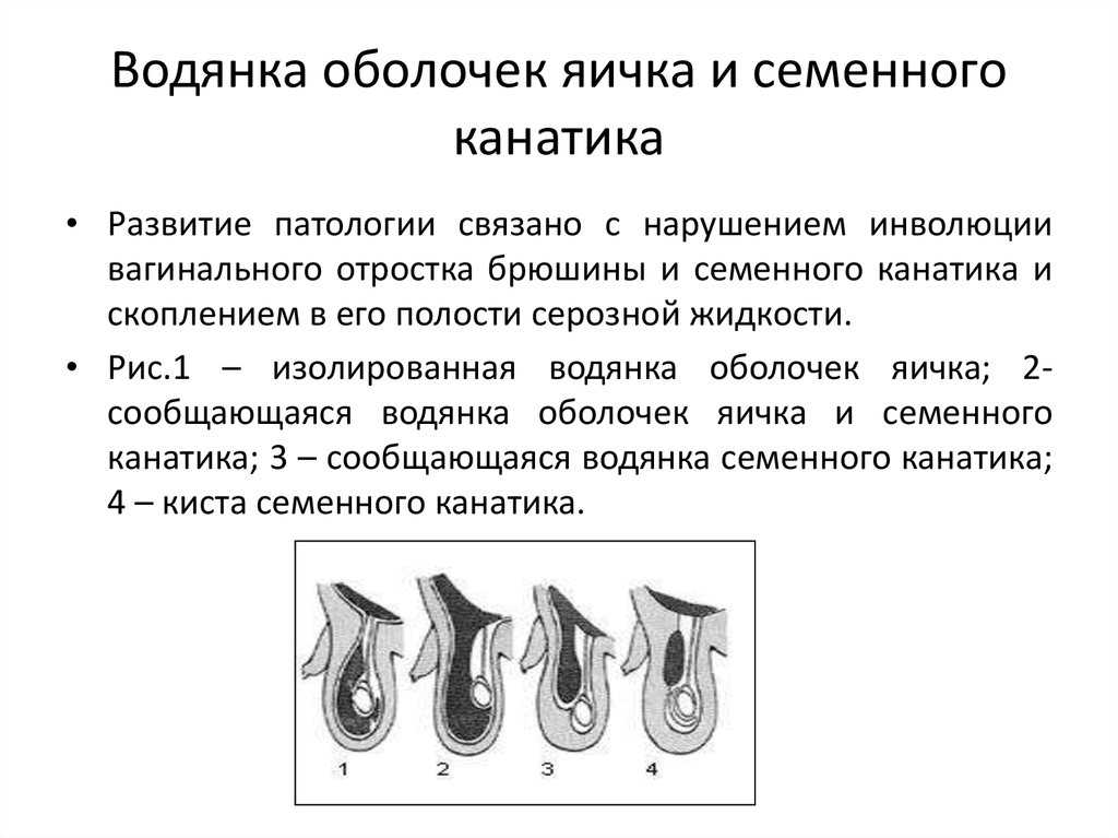Водянка яичка (гидроцеле) у мужчины, у мальчика, у новорожденных детей – описание и причины болезни, симптомы и диагностика, лечение (операция, пункция), отёк после операции