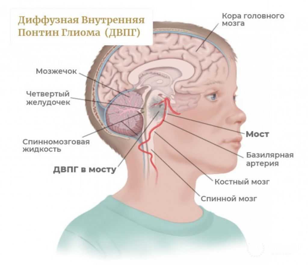 Опухоли головного мозга у детей: симптомы и лечение заболеваний