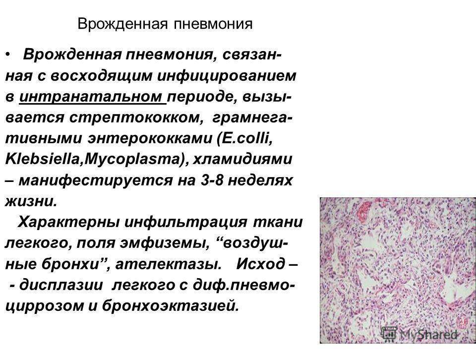 Клебсиелла пневмония: симптомы и лечение бактериофагом
