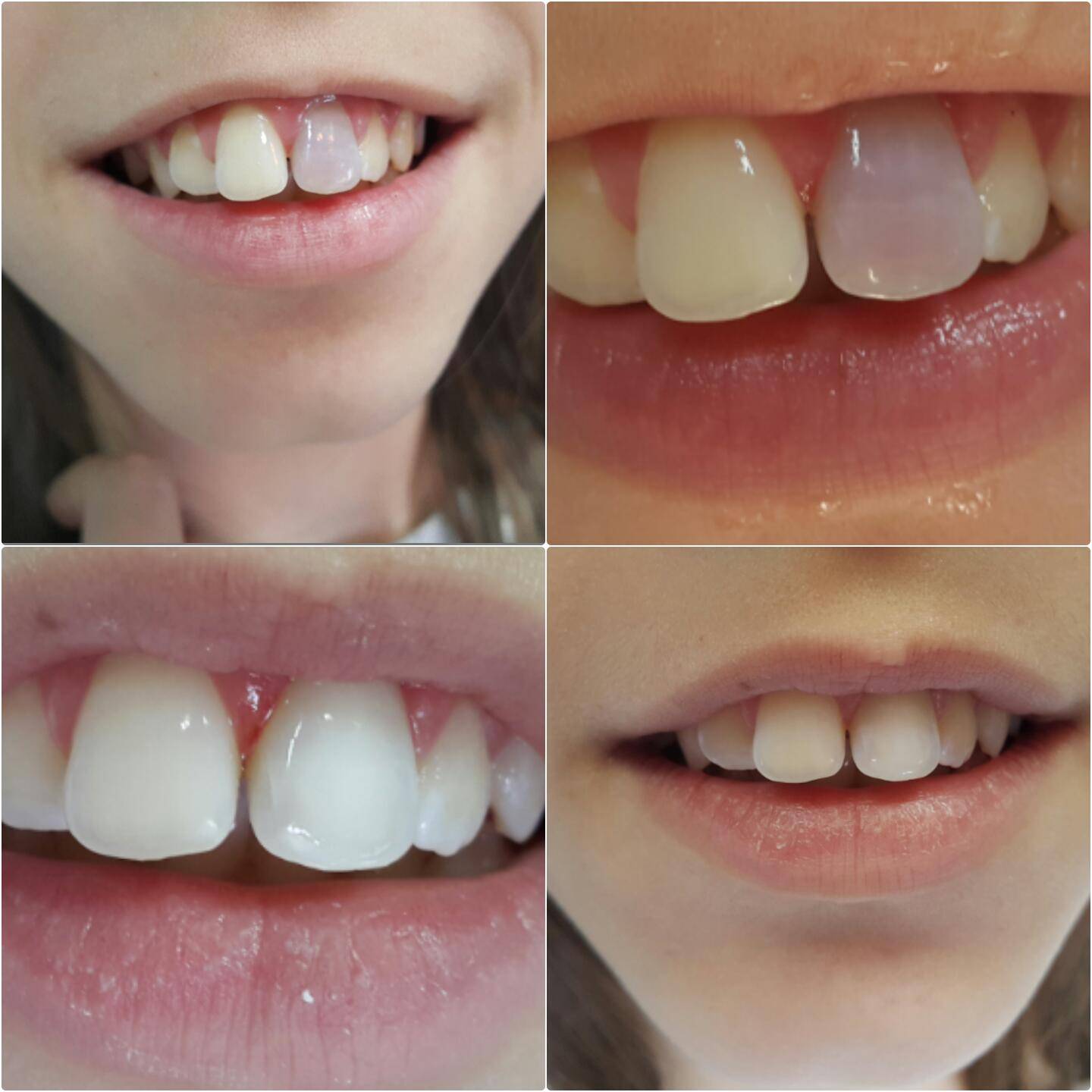 Синяя десна при прорезывании зубов у ребенка с фото: причины и лечение гематомы