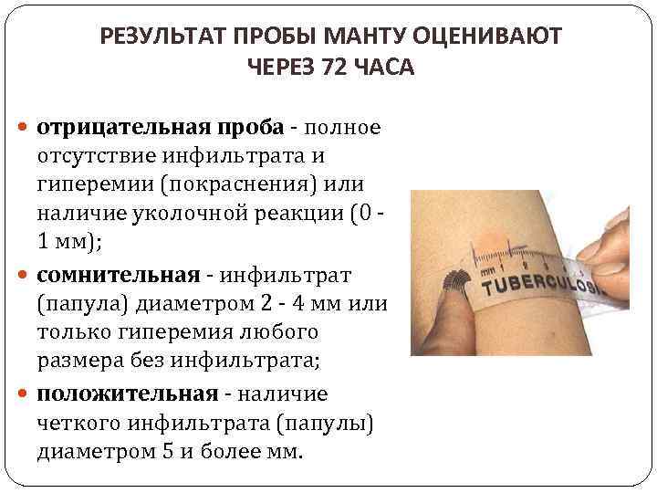 Отрицательная реакция манту или ее нет - что это значит, хорошо или плохо, что пуговка отсутствует?