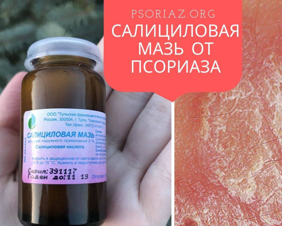 Отрубевидный лишай: лечение народными средствами, чемеричная вода, отзывы