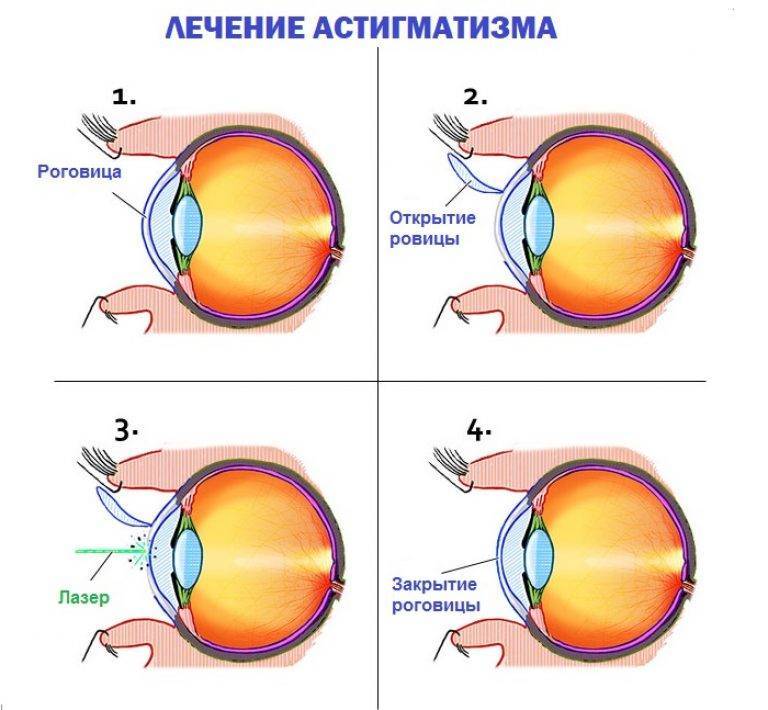 Гиперметропический астигматизм у детей: диагностика, лечение - "здоровое око"