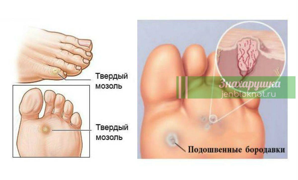 Подошвенная бородавка у ребенка на ноге: как избавиться и чем лечить | mfarma.ru