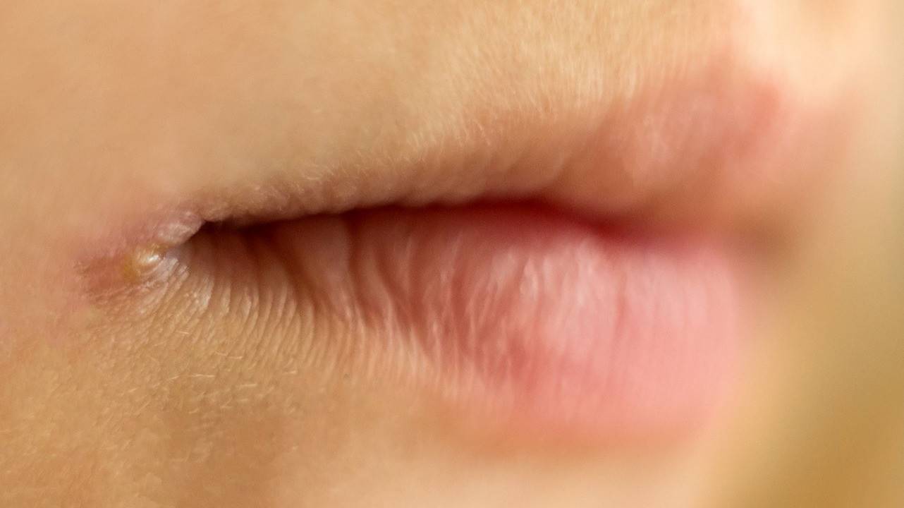 Заеды у ребенка в уголках рта: причины, лечение и профилактика