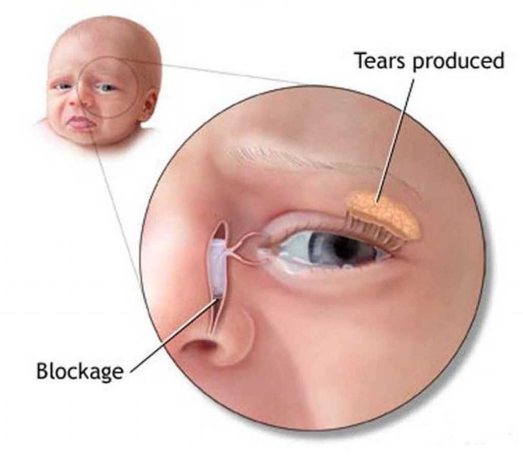Гноится глаз у новорожденного