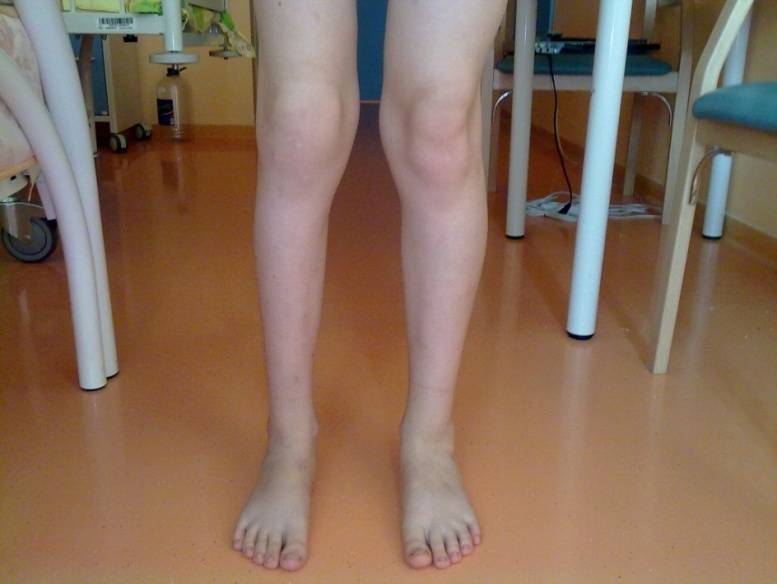Артрит коленного сустава у ребенка: лечение и причины ювенильного детского артрита